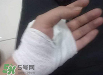 傷口化膿怎么處理？傷口化膿用什么藥好？