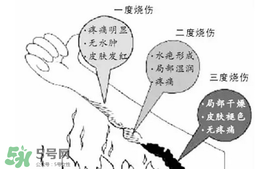 燙傷起泡要挑破嗎？燙傷起泡怎么處理？