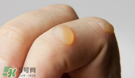 燙傷起泡要挑破嗎？燙傷起泡怎么處理？