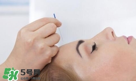 叢集性頭痛會死人嗎？叢集性頭痛的特點(diǎn)