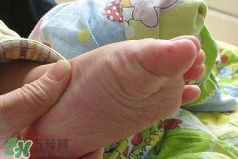 手足口病如何預(yù)防？手足口病怎樣預(yù)防