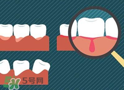 牙齦出血是什么原因？牙齦出血怎么回事