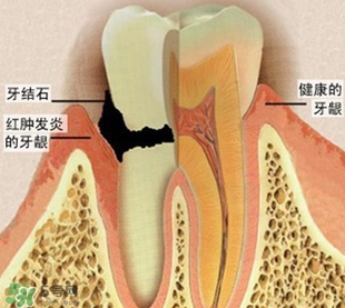 牙結(jié)石是什么？牙結(jié)石圖片