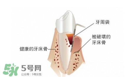 牙周炎怎么治療？牙周炎怎么治好