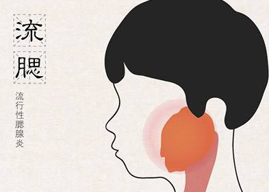 流行性腮腺炎有哪些癥狀？流行性腮腺炎的癥狀