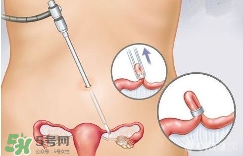 女人怎樣避孕最安全？對女人最好的避孕方法