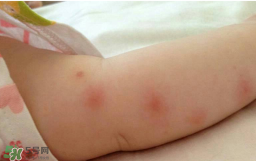 嬰兒蚊子咬了怎么消腫？嬰兒蚊子咬了怎么消腫止癢最快？