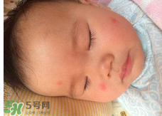 嬰兒蚊子咬了怎么消腫？嬰兒蚊子咬了怎么消腫止癢最快？