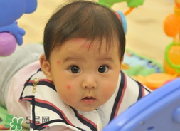 嬰兒被蚊子咬了如何去紅點(diǎn)？被蚊子咬后紅點(diǎn)如何去除？