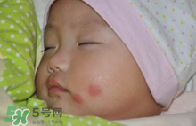 嬰兒被蚊子咬了如何去紅點(diǎn)？被蚊子咬后紅點(diǎn)如何去除？