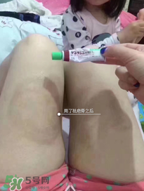 日本msd祛疤膏怎么樣？日本msd祛疤膏有用嗎？