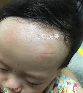 日本msd祛疤膏是抗生素嗎？日本msd祛疤膏是不是抗生素？