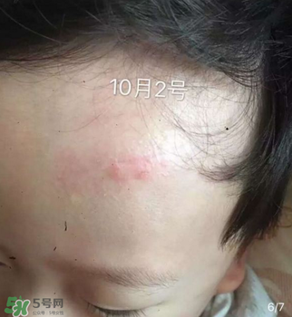 日本msd祛疤膏是抗生素嗎？日本msd祛疤膏是不是抗生素？