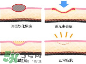 藥水點(diǎn)痣和激光點(diǎn)痣哪個(gè)好？各有什么優(yōu)缺點(diǎn)