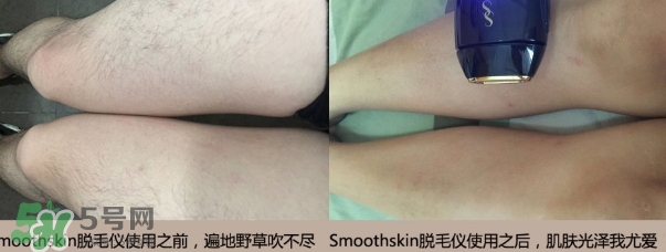 smoothskin和slikn infinity哪個(gè)好？smoothskin脫毛儀怎么樣