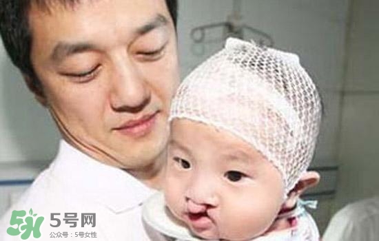 兔唇是什么？兔唇是什么原因造成的？
