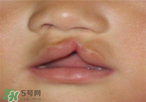 兔唇能檢查出來嗎？兔唇能完全修復嗎？