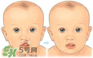 兔唇能檢查出來嗎？兔唇能完全修復嗎？
