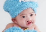 兔唇可以治嗎？兔唇修補術(shù)