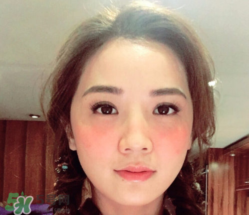 夏天可以點(diǎn)痣嗎？夏天點(diǎn)痣后要注意什么？