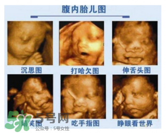 四維彩超有必要做嗎？四維彩超檢查不出什么？