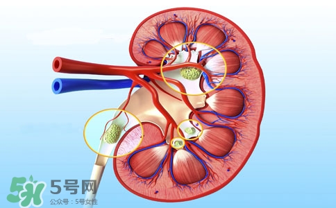 腎結(jié)石有什么癥狀？腎結(jié)石原因