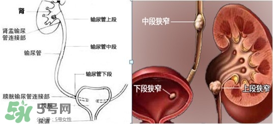 腎結石怎么治最好？腎結石的醫(yī)治方法