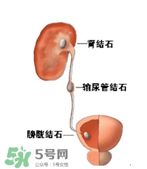 腎結(jié)石有什么癥狀？腎結(jié)石原因