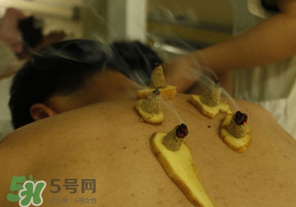 三伏灸有用嗎？2017年三伏艾灸時間