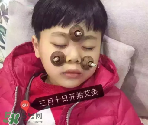 艾灸貼可以治咳嗽嗎？艾灸貼可以治退燒嗎？