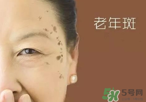 老年斑多大年齡開始有？為什么牙膏能去老年斑？