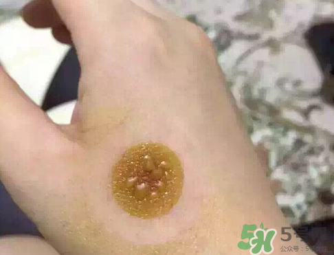 艾灸貼后有水泡怎么辦？貼艾灸貼應注意些什么？