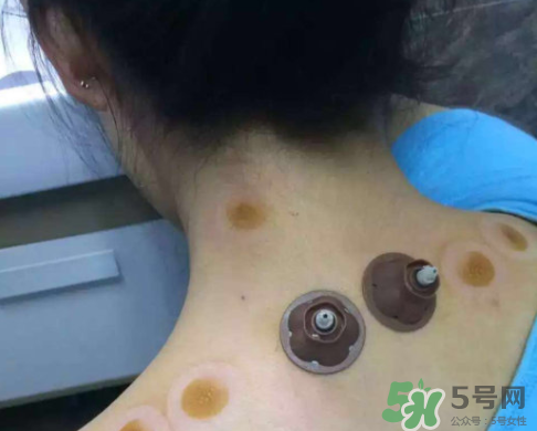 艾灸貼后有水泡怎么辦？貼艾灸貼應注意些什么？
