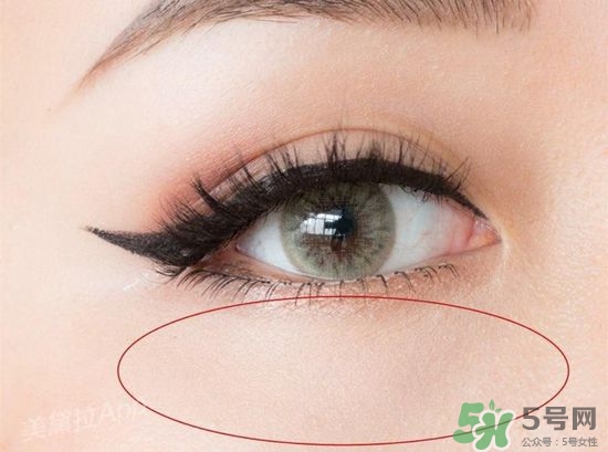 玻尿酸填充淚溝多久恢復自然？玻尿酸填充淚溝的危害