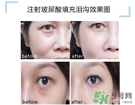 玻尿酸填充淚溝多久恢復自然？玻尿酸填充淚溝的危害