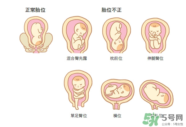 胎位不正如何矯正？胎位不正一定要剖腹產嗎？
