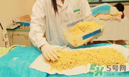 隔姜灸效果怎么樣？隔姜灸好還是直接灸好