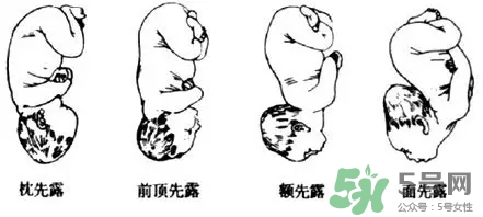 胎位不正能順產(chǎn)嗎？胎位不正怎么辦？