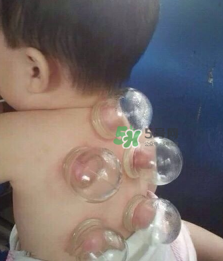 拔火罐后顏色多久消失？拔火罐印子多久能消除？