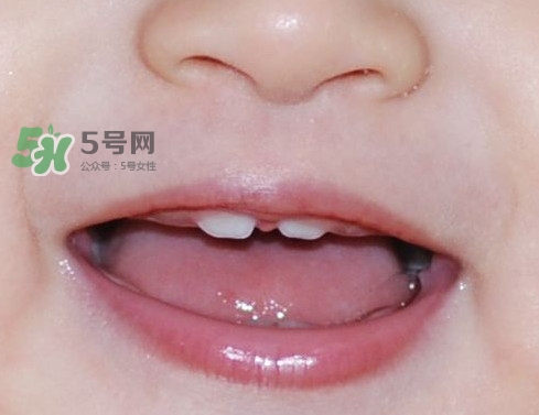 牙齒縫隙大怎么辦？牙縫大帶牙套有用嗎