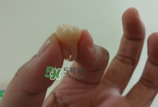 拔智齒痛嗎？智齒拔了多久洞會好？