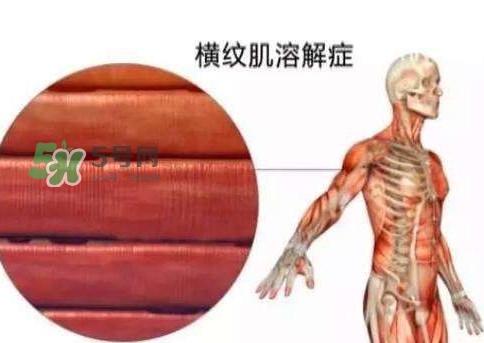 橫紋肌溶解癥會死亡嗎？橫紋肌溶解癥能活多久