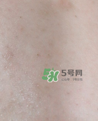 Dermatix舒痕疤痕膏有效嗎？Dermatix舒痕疤痕膏怎么用？