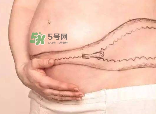 剖腹產疤痕怎么去除？剖腹產疤痕能去掉嗎？