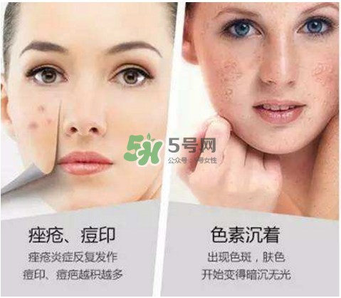 果酸換膚自己可以做嗎？果酸換膚后注意事項(xiàng)