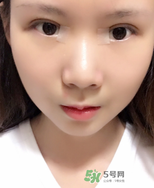 美皮護去疤效果怎么樣？美皮護有用嗎？