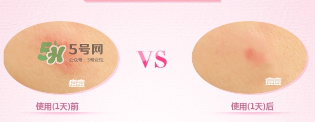 3m痘痘貼怎么用？3m痘痘貼貼多久？