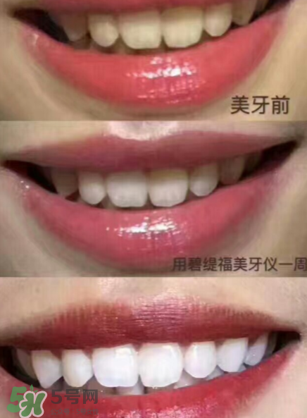 美牙儀能用水洗嗎？美牙儀能用多久？