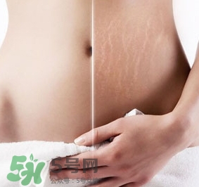 妊娠紋什么時候變白？妊娠紋產(chǎn)品什么時候用？