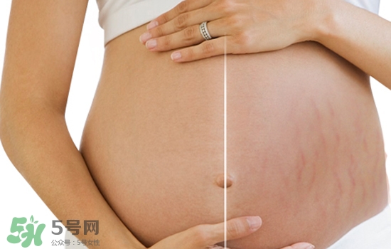 妊娠紋在左邊生男或女？怎么從妊娠紋看男女？
